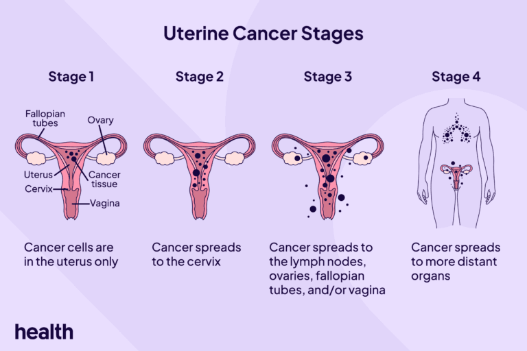 hdc infographic uterinecancerstages 1 final 1 2 8d180e670e0c4aa38028b9c655cb6b9d.png