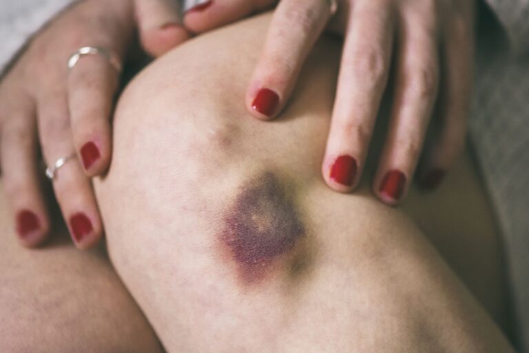 bruise gettyimages 1138335427 bb962d3ef2dc477f8e1cc8098649a148.jpg
