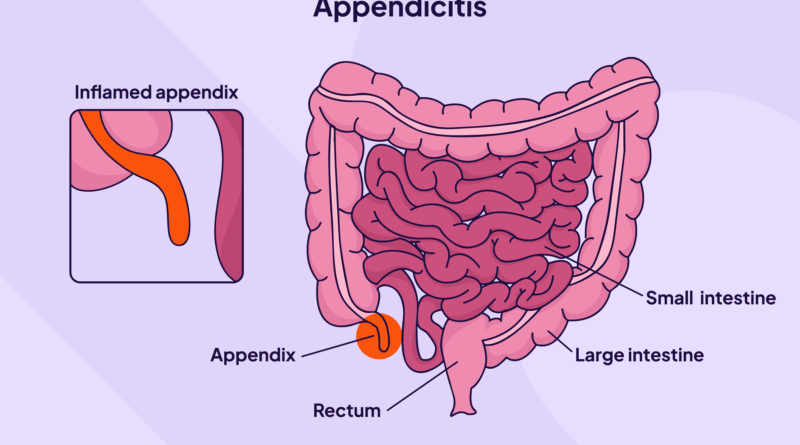 hdc infographic stages of appendicitis 1 v1 1 b82cec7d8631478c8d2f84835557a9cc.png