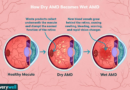 how dry amd becomes wet amd 4770108 209bcafcdd694d5f85bdd5f15d3a61a9.png