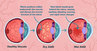 how dry amd becomes wet amd 4770108 209bcafcdd694d5f85bdd5f15d3a61a9.png