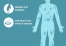 urticaria symptoms 5b55f74746e0fb0037d9ef2a.png