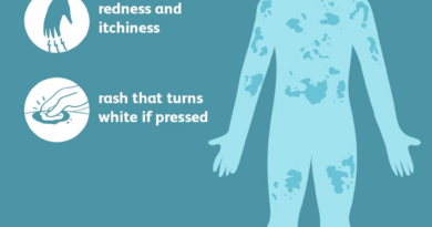 urticaria symptoms 5b55f74746e0fb0037d9ef2a.png