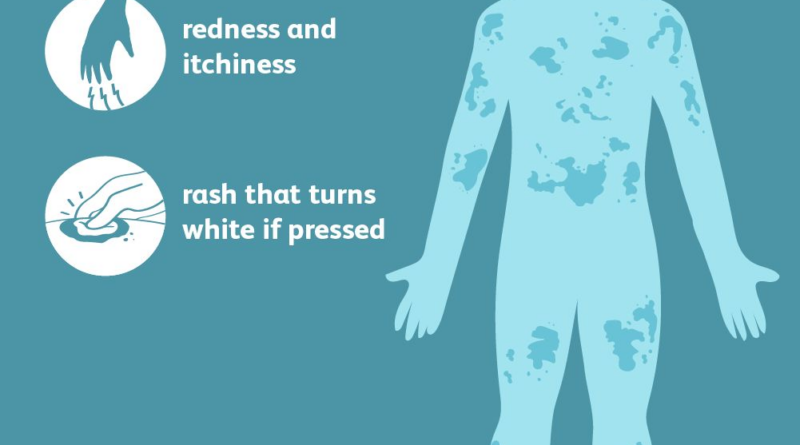 urticaria symptoms 5b55f74746e0fb0037d9ef2a.png