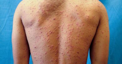 vwh dermnetnz chickenpoxrash 01 71d98606a8004607be2f795131cecd03.jpg