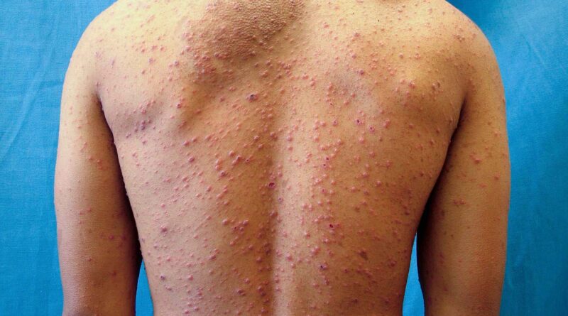 vwh dermnetnz chickenpoxrash 01 71d98606a8004607be2f795131cecd03.jpg